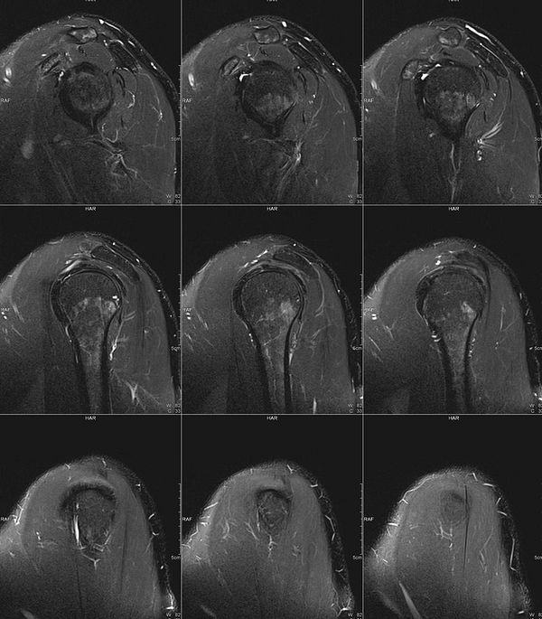 MRI scan images of a left upper arm injury displayed on a medical imaging software interface.