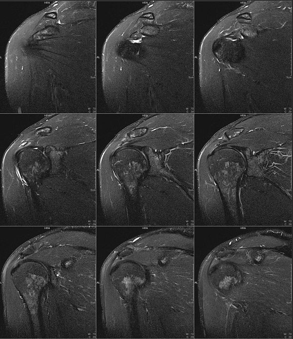 Axial T1-weighted MRI scan of the left upper arm showing detailed anatomy including humerus, muscles, and fat.