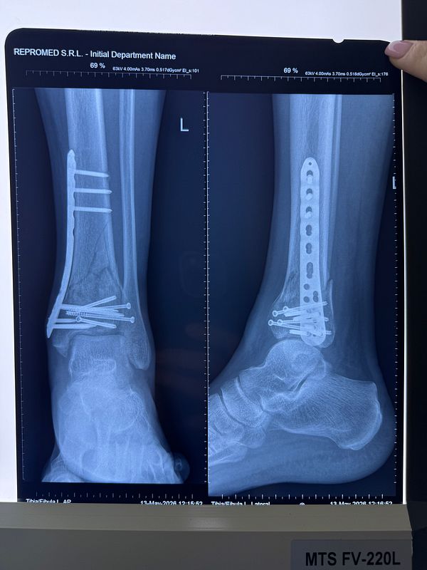 A medical X-ray image showing an ankle with visible surgical hardware.