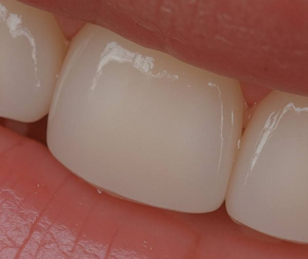 A close-up view of two adjacent teeth with a focus on their surface texture and shine.