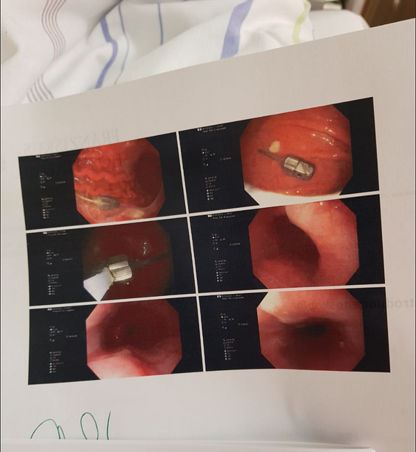 The image displays a series of endoscopic images showing the removal of a screw from the throat.