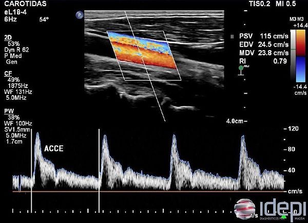 Ultrasound medical scan image showing a clear neck artery with no plaque detected.