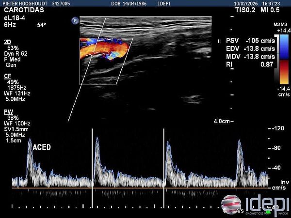 Ultrasound image of the carotid artery displaying a clean lumen without plaque formation.