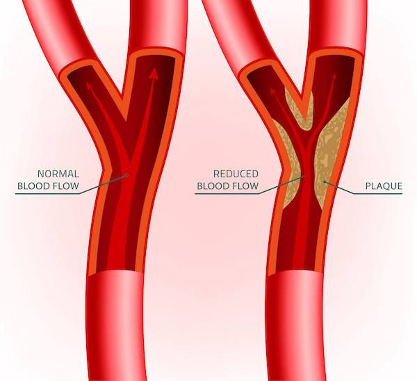 Ultrasound scan image showing carotid arteries with measurement annotations and Doppler waveform.