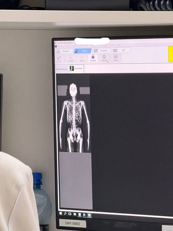 Photo of a male patient undergoing a DEXA scan, lying on a scanning table with medical equipment and monitors around.