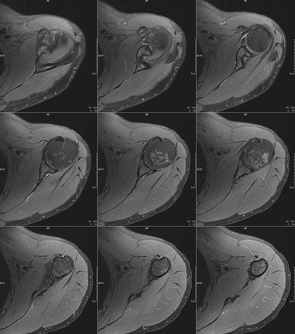 MRI scan image displaying a cross-sectional view of the left upper arm with muscle and tissue details.