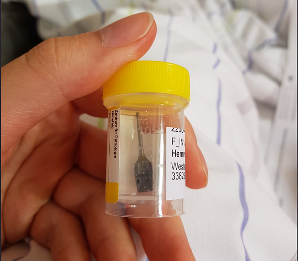 A person holds a specimen container with a long screw inside, which was removed after a dental incident.