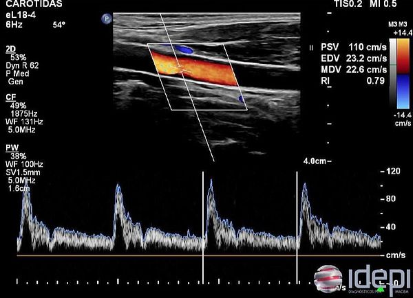 Ultrasound images displaying the carotid arteries with color flow mapping indicating blood flow.